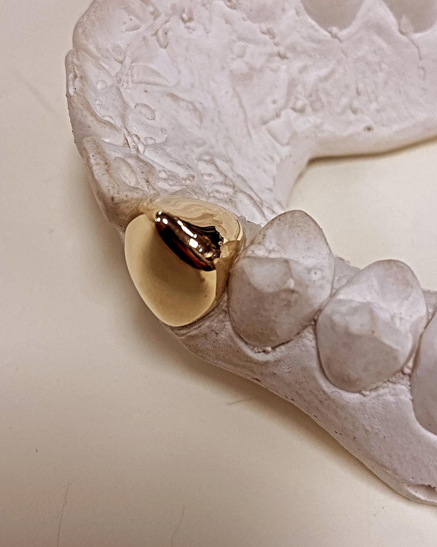 One tooth capped in 9kt gold, your design of choice